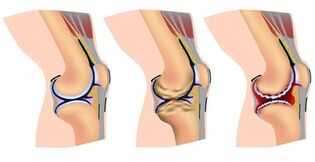 a térd és a láb artrózisának kezelése